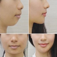 lifting chin, neck tightening cream