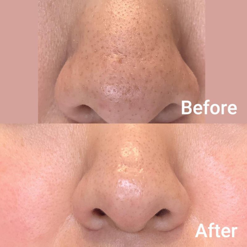 medicube, Zero Pore Pad